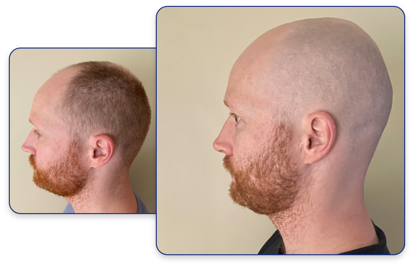 Gillette baldly Photo before head shaving